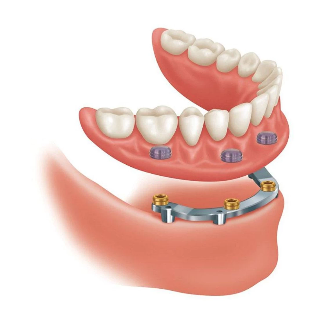 Prótese Dentária Fixa 