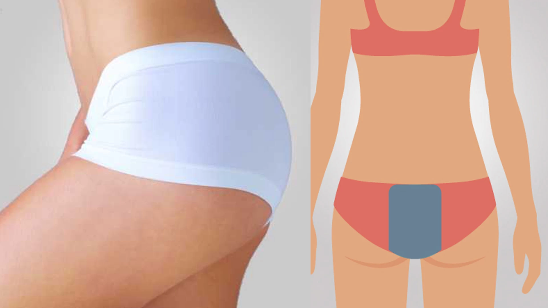 Depilação Glúteos Médios